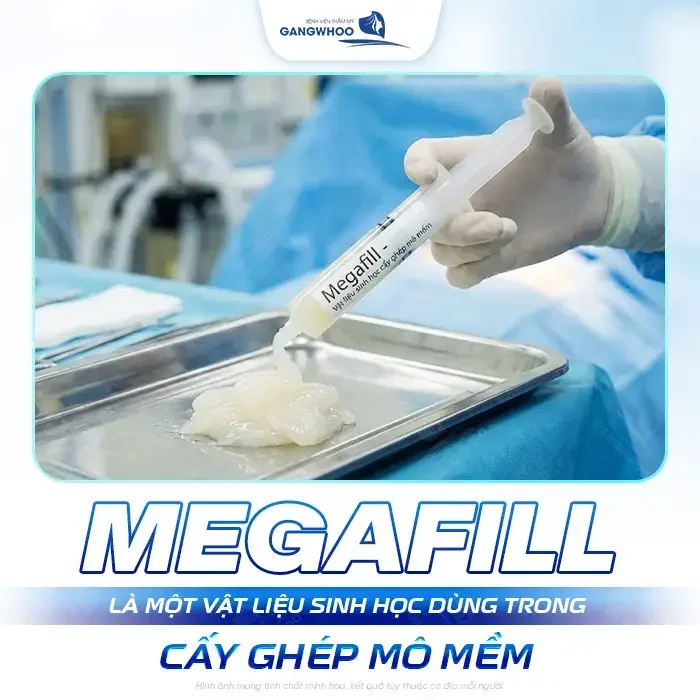 Tăng Kích Thước Dương Vật Bằng Tiêm Chất Làm Đầy Độn Mô Megafill (2)